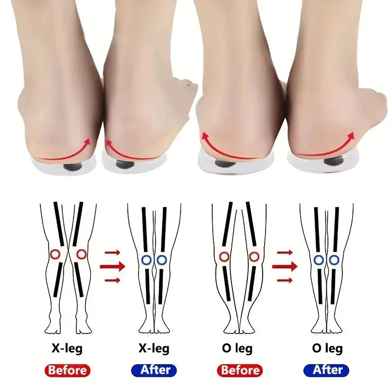 Semelles orthopédiques en gel magnétique ORTHOFIX pour la correction des jambes O/X et le soulagement des chocs